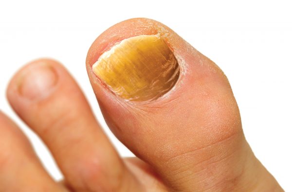 Infected Toe